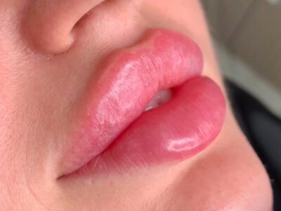 Збільшення губ